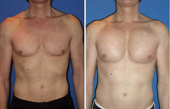 Пластика грудных желез фото до и после