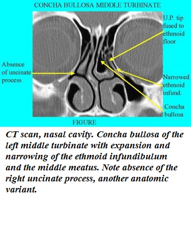 Concha bullosa средних носовых раковин что это