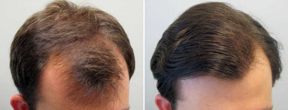 Как тестостерон влияет на выпадение волос на голове у женщин