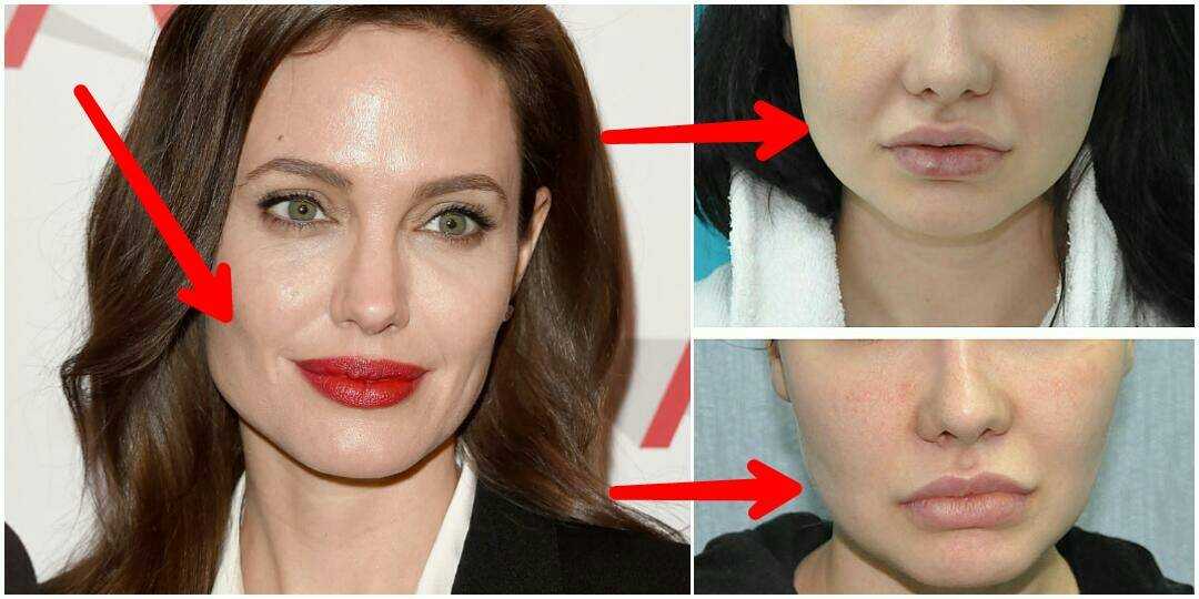 Видны скулы. Анджелина Джоли мешки Биша.