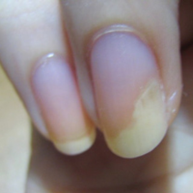 От чего слоятся ногти на руках. Детские ногти отходят от кожи.