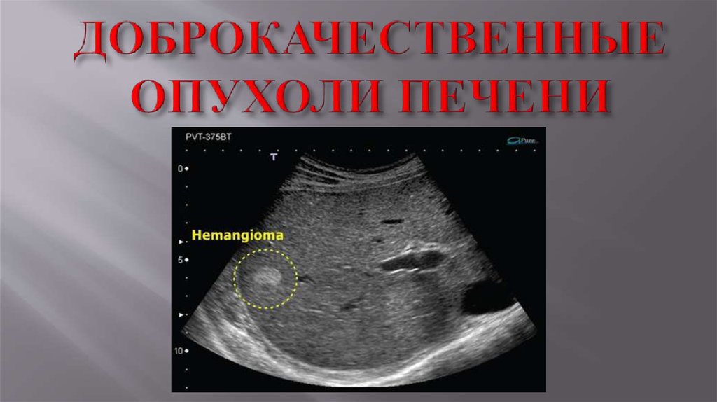 Гемангиома печени симптомы. Доброкачественная опухоль печени на УЗИ. Злокачественные опухоли печени УЗИ признаки. Новообразование в печени на УЗИ.