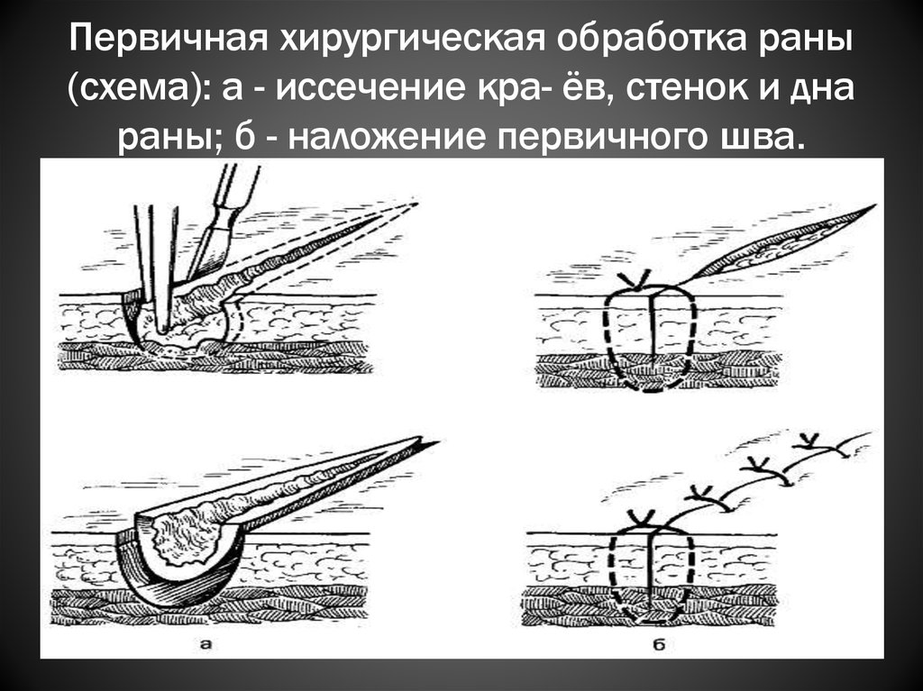 Снятие швов схема