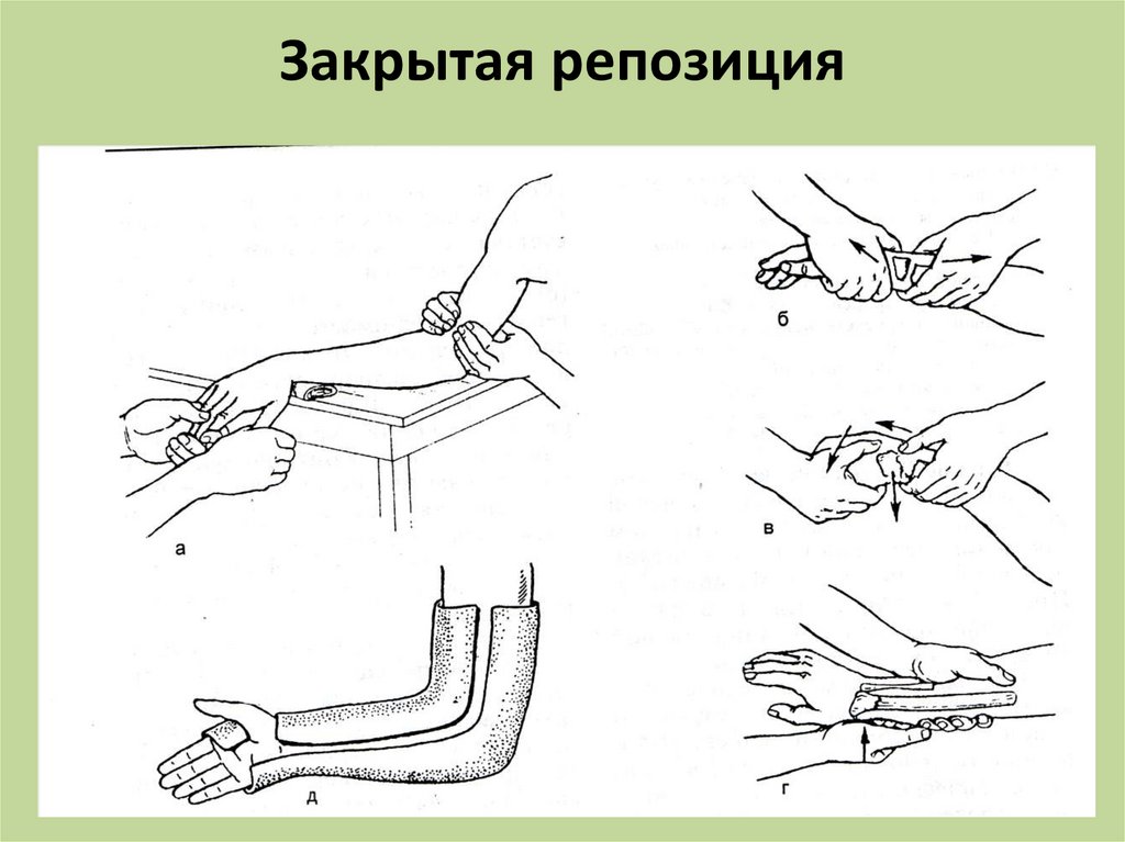 Репозиция костей. Закрытая ручная репозиция костных отломков. Закрытая репозиция лучевой кости со смещением. Закрытая репозиция перелома лучевой кости. Закрытая репозиция перелома коллеса.