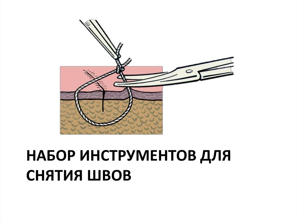 Снятие швов картинки