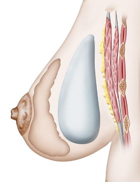 Импланты грудных желез