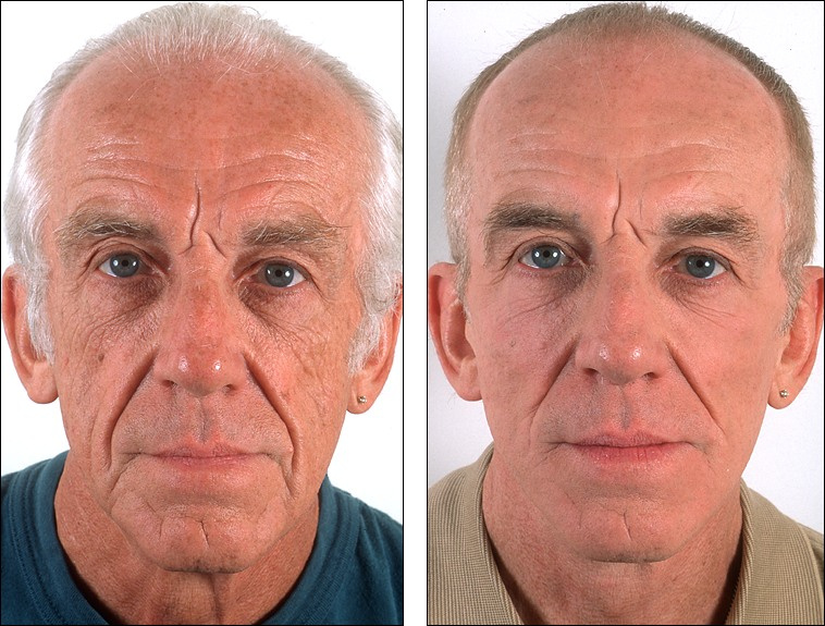 Почему мужчина стареет. Морщины у мужчин. Омоложение лица до и после. Старое лицо. Морщины на лице.
