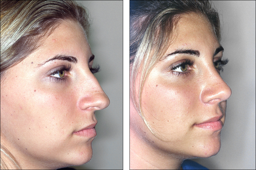 Операция на кончик носа. Ринопластика Эленшлегер. Бурун ринопластика. Нос до и после ринопластики.