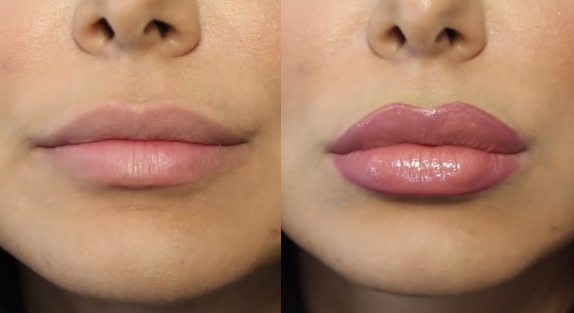 Увеличение губ lips. Губы гиалуроновой кислотой. Форма губ гиалуроновой кислотой. Красивая форма губ.