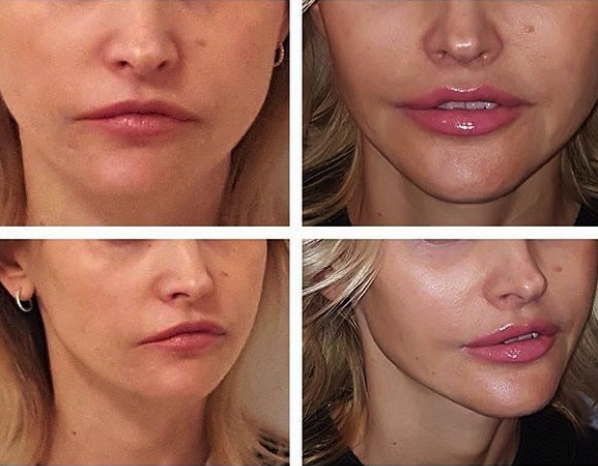 Увеличение губ хирургическим путем фото до и после