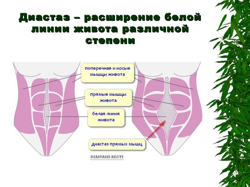 Диастаз прямых мышц живота. Диастаз прямых мышц живота на УЗИ. Диастаз прямых мышц живота на УЗИ протокол. Диастаз прямой мышцы живота на УЗИ. Расширение белой линии живота.