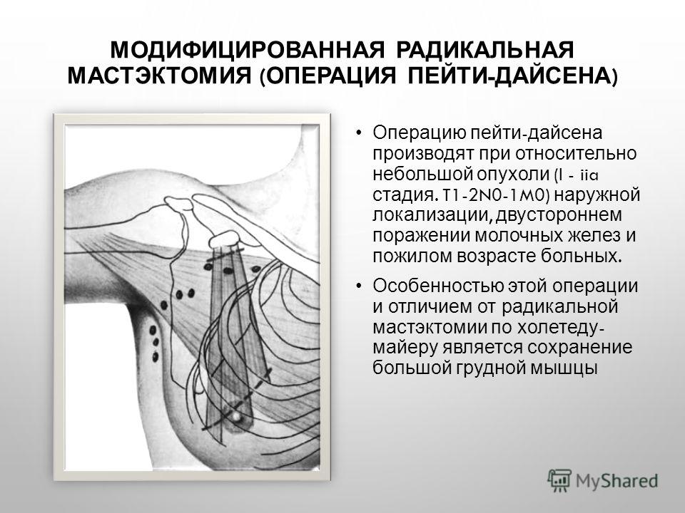 Радикальная мастэктомия. Операция радикальная мастэктомия по Маддену. Радикальная мастэктомия по Холстеду Майеру. Радикальная мастэктомия по пейти-Дайсону это. Радикальная мастэктомия по Маддену протокол операции.