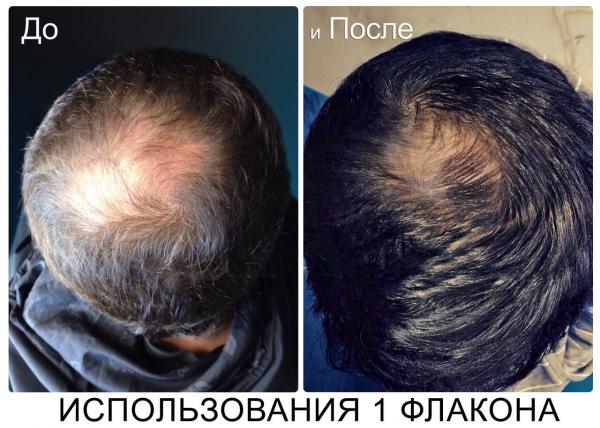 Как ускорить рост волос мужчине на голове. Рост волос на голове. Средство для роста волос на голове. Генеролон спрей для выпадения волос для мужчин. Рост волос при алопеции.