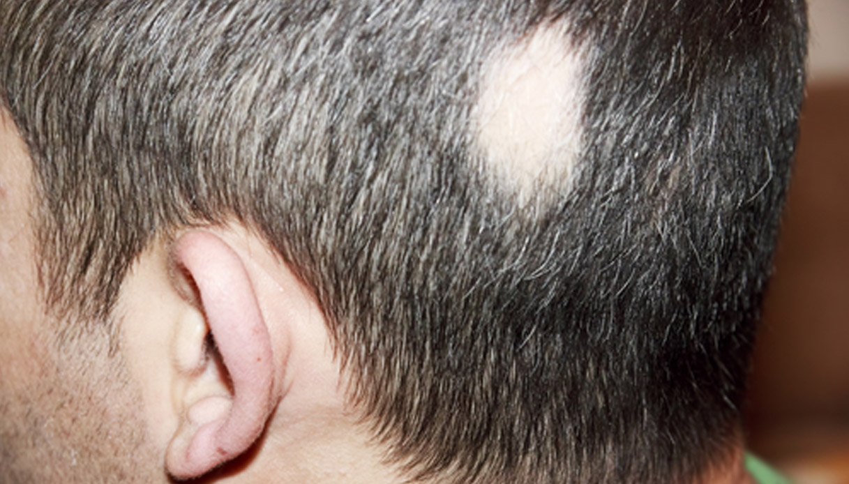 Волосы на ушах у мужчин. Гнёздная (очаговая алопеция). Очаговая алопеция (alopecia Areata). Очаговая алопеция офиазис Цельса.