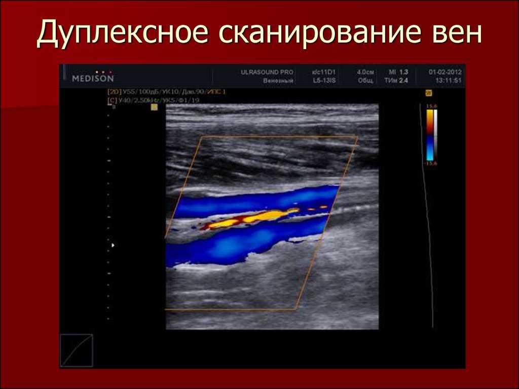 Дуплексное сканирование вен