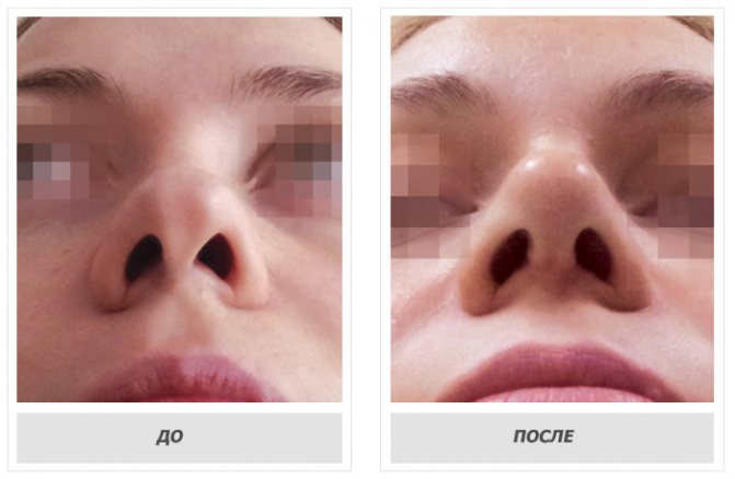 Искривление носовой перегородки операция. Ринопластика кончика носа. Перегородка носа без операции