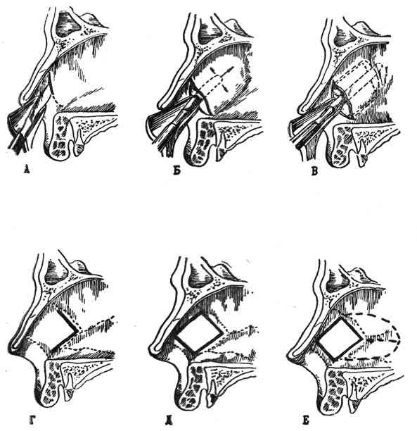 Перфорация носовой перегородки лечение. Подслизистая резекция носовой перегородки. Операция подслизистая резекция носовой перегородки. Редрессация носовой перегородки. Септопластика, подслизистая резекция носовой перегородки.