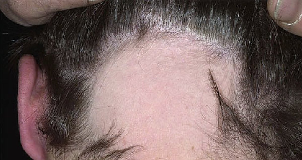 Волосы на ушах у мужчин. Гнёздная (очаговая алопеция). Себорейный дерматит на бороде. Себорейный дерматит это лишай. Себорейный дерматит малассезия.