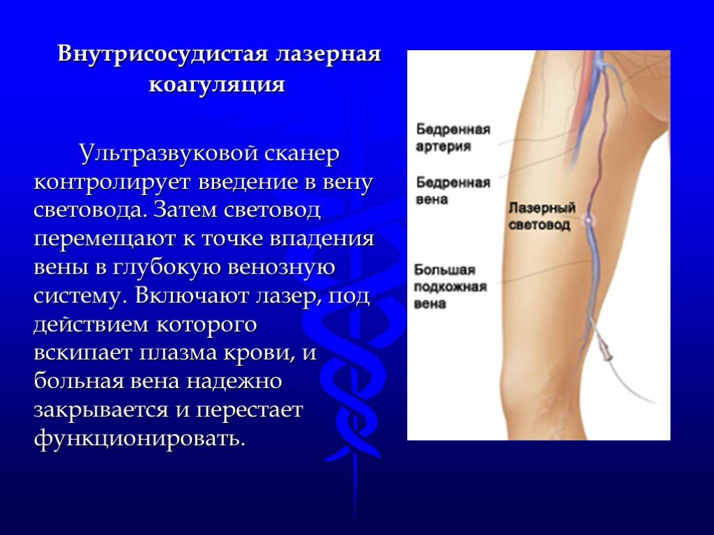 Вены лазерная коагуляция. Внутрисосудистая коагуляция.