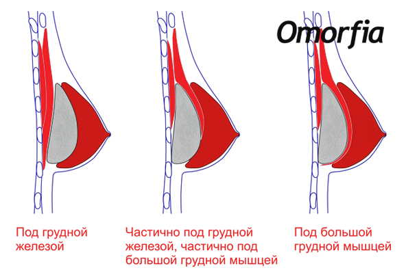 Имплант под грудную мышцу