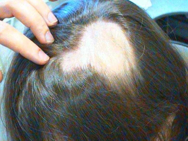 Почему выпадают волосы на голове у подростка