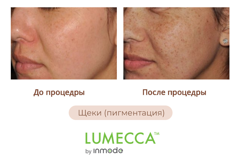 Lumeca фотоомоложение. Lumecca аппарат IPL. INMODE Lumecca.