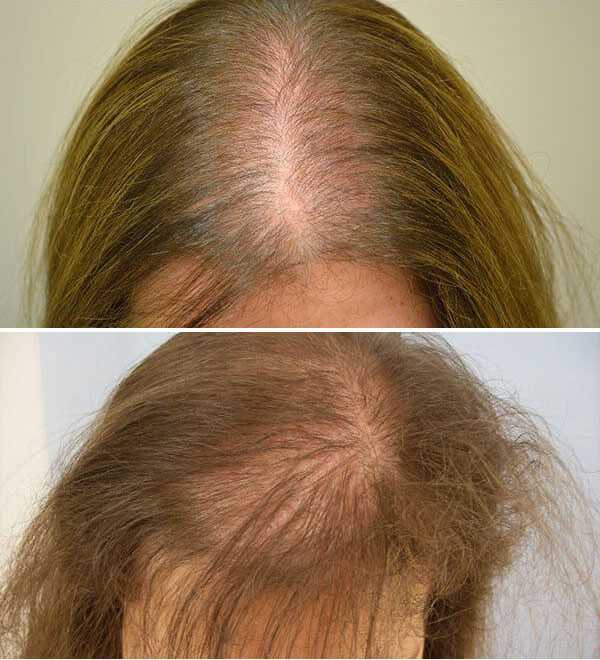 Почему волосы на голове медленно. Волосы не выпадают но редеют. Елочка на голове выпадение волос. Возрастное поредение волос у женщин.