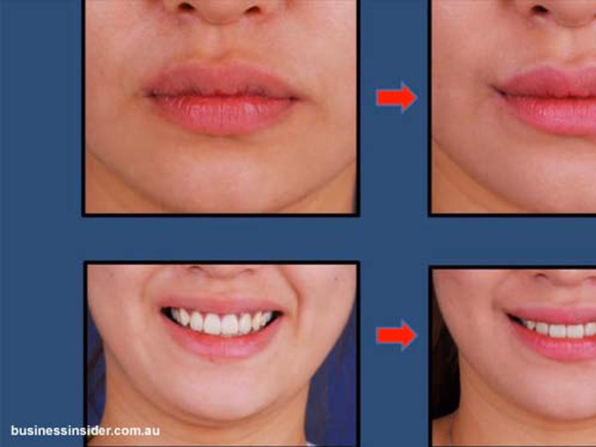 увеличение губ операция фото