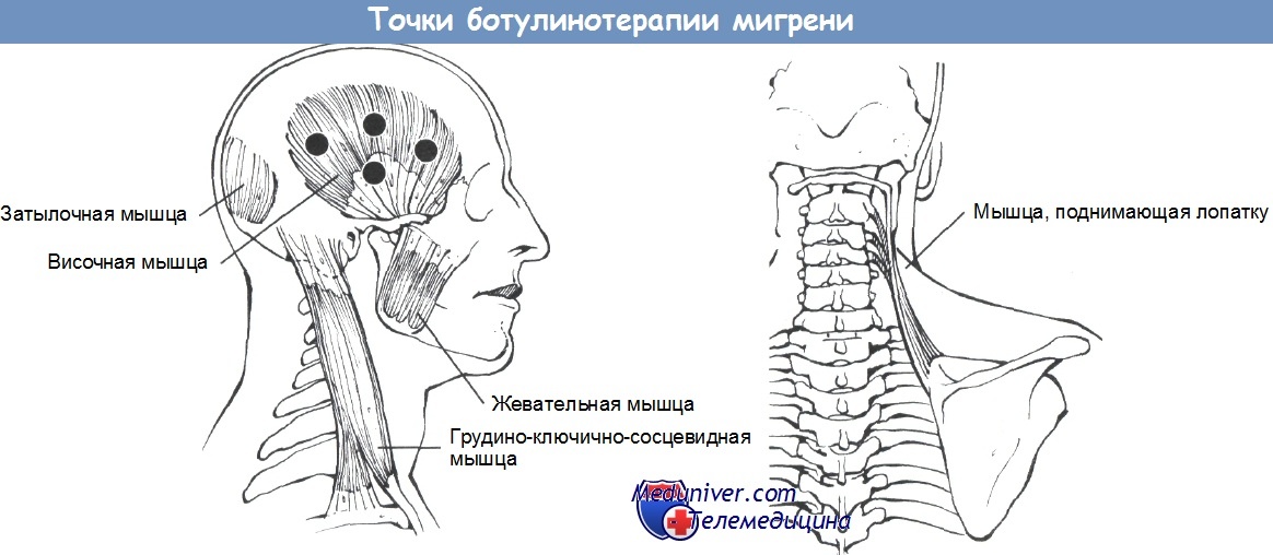 Ботулинотерапия при мигрени отзывы. Схема введения ботокса при мигрени. Схема ботулинотерапии при мигрени. Ботулинотерапия при мигрени точки. Ботокс схема введения при мигрени.