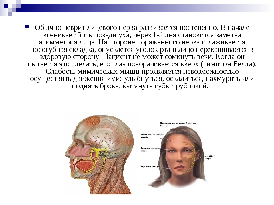 Невропатия боль. Клинические проявления при неврите лицевого нерва. При неврите лицевого нерва страдают мышцы :. Неврит лицевого нерва тактика фельдшера. Основной синдром при неврите лицевого нерва:.