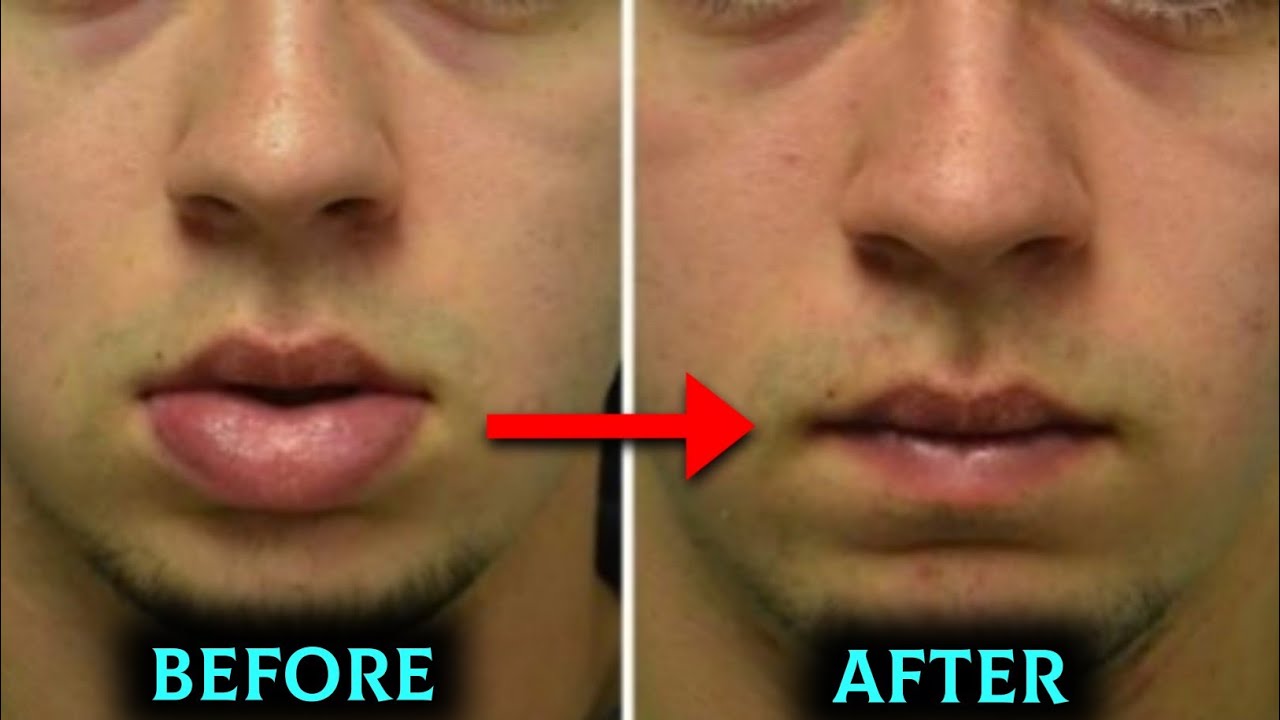 Операция нижней губы. Хейлопластика мужская. Губы мужчины.
