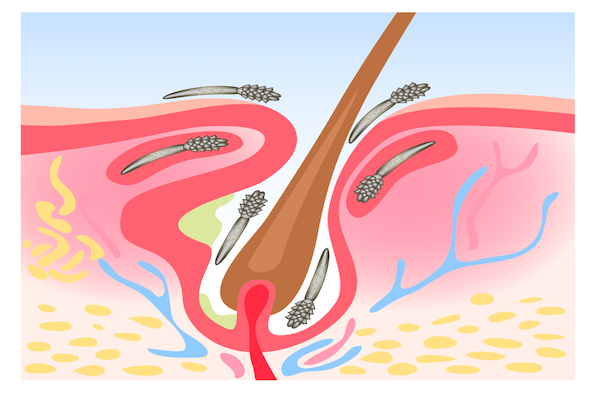 Клещ демодекс. Клещ демодекс фолликула. Демодекоз волосяного фолликула. Цикл развития демодекса у человека.