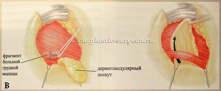 Ю фрагмент. Лоскут большой грудной мышцы. ДЕРМОГЛАНДУЛЯРНЫЙ лоскут. Торакодорзальный лоскут. Лоскут из грудной мышцы.