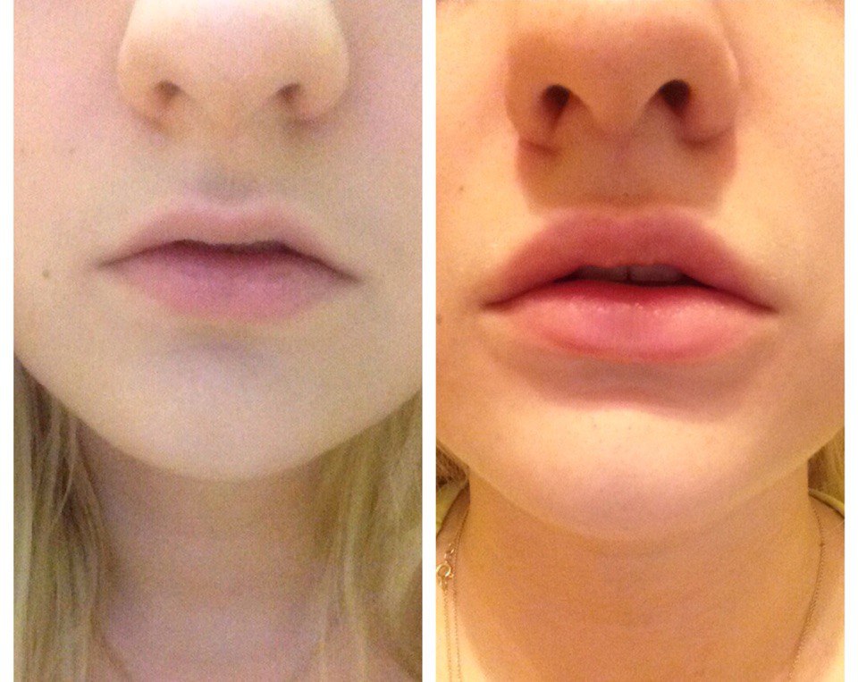 Увеличение губ до и после отзывы. Губы 0 6 мл гиалуроновой кислотой. Тонкие губы гиалуроновой кислотой. Уколы гиалуроновой кислоты в губы.