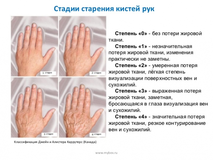 Карта изменения рук. Возрастные изменения кожи рук.