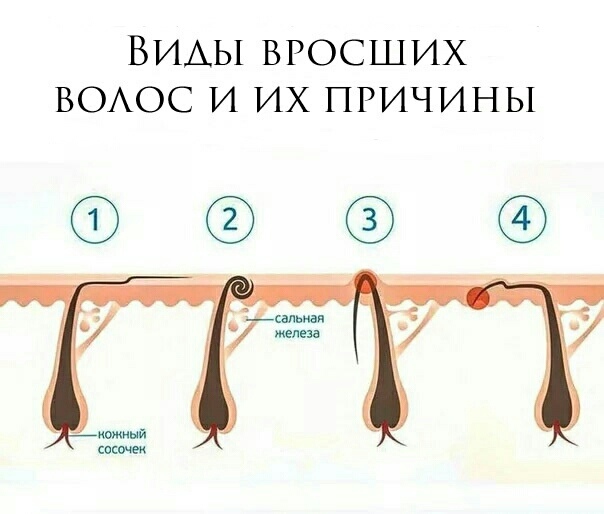 Через сколько растут волосы после депиляции воском