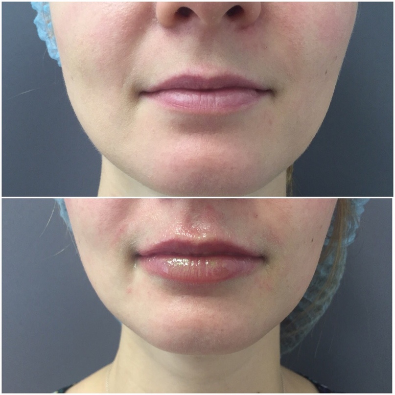 Увлажнение губ до и после. Regenyal Lips. Увлажнение губ гиалуроновой кислотой. Regenyal idea филлер.