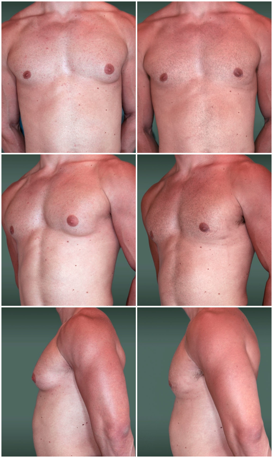 рост груди у бывших мужчин фото 28