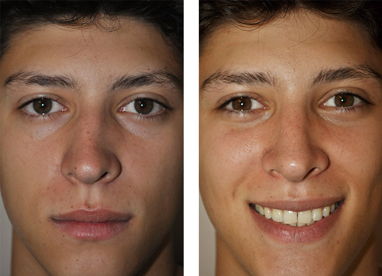Можно вправить нос. Кривой нос до и после операции. Септопластика до и после операции.
